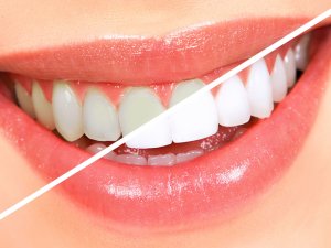Diş Eti Estetiği İle Artık Daha Rahat Gülümseyebilirsiniz