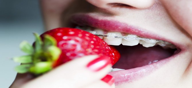 Diş Teli İle İlgili 5 Önemli Bilgi