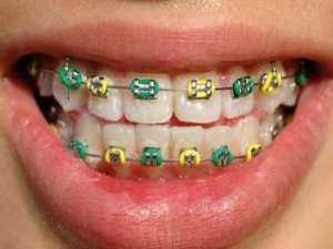 Çocuklarda Diş Teli Tedavisi
